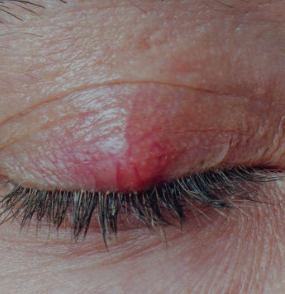 Red Bump on Eyelid? Possible Causes and Simple Home Care Tips