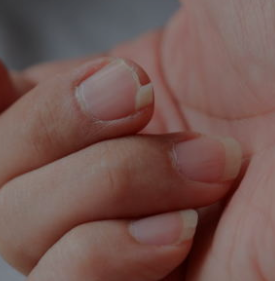 Brittle Nails: Common Causes and What They May Indicate